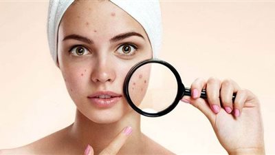 خطوات العناية ببشرتك الدهنية خلال فصل الصيف وحمايتها من الحبوب