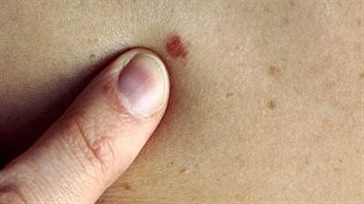 «تينيا القدم» يهدد مسيرة الرياضيين.. أستاذ جلدية يقدم روشتة للعلاج.. «الناظر»: 5 أسباب تؤدي للمرض.. وتجفيف القدم وعدم استعمال جوارب وأحذية الآخرين «بداية الوقاية»