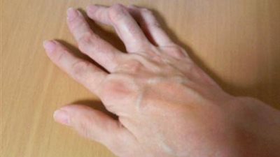 المصابون بـ