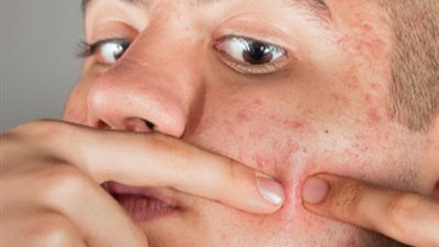 دراسة تكشف دور الدهون والهرمونات الجنسية لمرضى حب الشباب