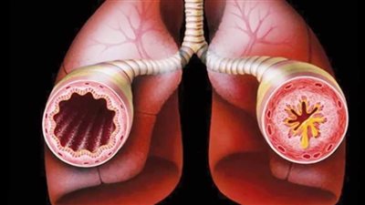 أسباب الإصابة بـ«الربو القصبي» وطرق العلاج