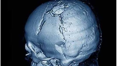 أسباب الإصابة بارتجاج المخ وطرق العلاج