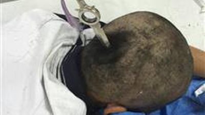 بالصور.. لقطات مروعة لسكين يخترق رأس طفلة