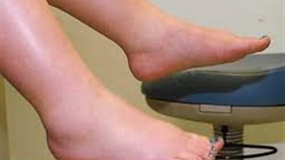 3 وصفات طبيعية لعلاج احتباس الماء بالجسم