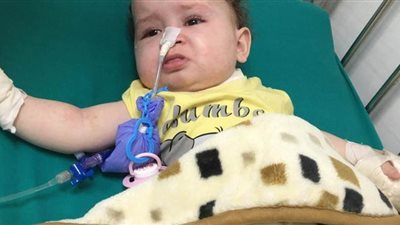 نجاح عملية زراعة قولون لطفلة عمرها 7 شهور في الإسكندرية