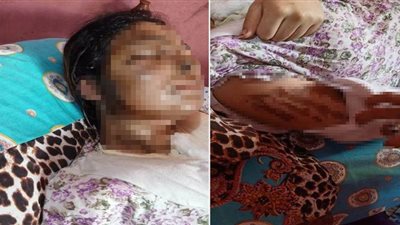 بسبب فسخ الخطوبة..  عامل يشوه وجه خطيبته بالخانكة