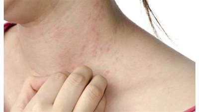 أسباب الإصابة بمرض الإكزيما وأسرع طرق العلاج
