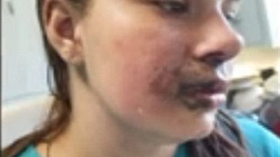 بالصور.. سيجارة إلكترونية تنفجر في وجه فتاة