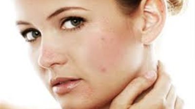 جل الصبار يخلصك من مشكلات حب الشباب في الصيف