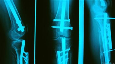 «الضوء الأزرق» طريقة مبتكرة لتقوية العظام