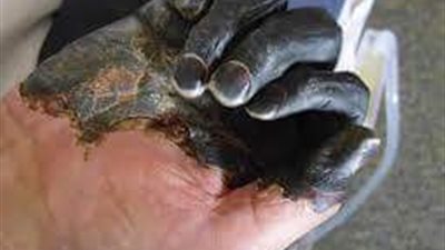 بالصور.. مشاهد خطيرة لإصابات ناتجة عن تناول قمح مصاب بالأرجوت