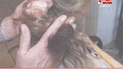 بالفيديو.. كيفية علاج «الصلع الوراثي»