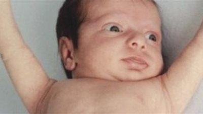 5 أعراض تؤكد إصابة طفلك بقصور الغدة الدرقية