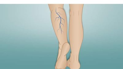 كل ما تود معرفته عن مرض دوالي الساقين .. الأسباب وطرق العلاج