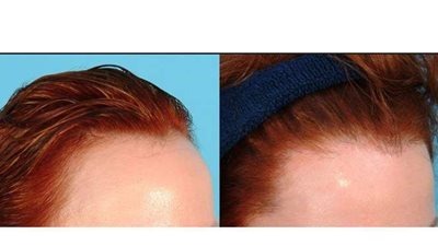 كيف يمكن زراعة منطقة التاج.. استشاري يشرح