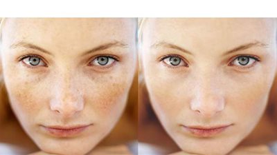 3 وصفات من الطبيعة تساعدك في علاج النمش