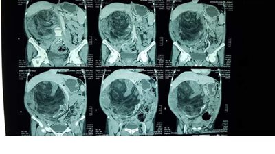 استئصال ورم  6704 جرامات من بطن مريض في جامعة المنصورة