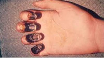 الدملي أكثر أنواعه انتشارا.. طرق انتقال الطاعون وانواعه وعلاجه