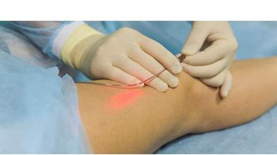 طريقتان لعلاج الدوالي بالليزر