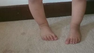 استشاري عظام يوضح طرق علاج اعوجاج العظام عند الأطفال