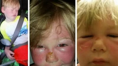 كريم واقٍ من الشمس يشوه وجه طفل