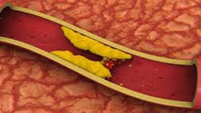 وصفة طبيعية تخفض الكوليسترول وتقاوم السرطان