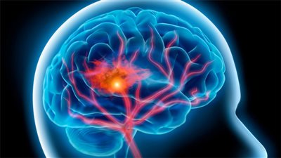 زرع خلايا عصبية في المخ بدلا من التالفة أصبح حقيقة وليس حلما