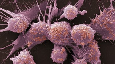 حرمان الخلايا السرطانية من الكوليسترول يساعد في قتلها ويسبب انحدارها