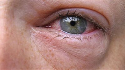 6 أعراض مرضية يسببها ارتفاع ضغط العين بعد الأربعين