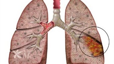 تحذير طبى.. طفلك معرض لـ