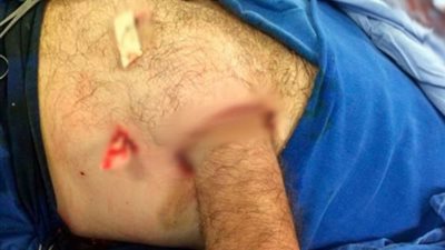 شاهد.. إنقاذ يد رجل برازيلى من البتر بخياطته في بطنه