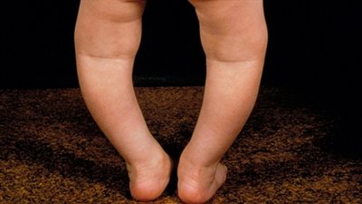 3 طرق تخلصك من مرض تقوس الركبة