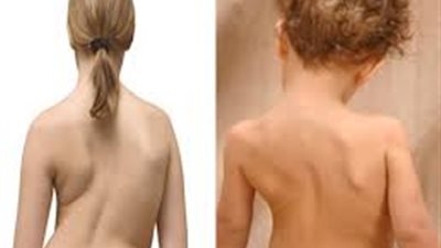3 أسباب وراء انحناء العمود الفقري عند الأطفال