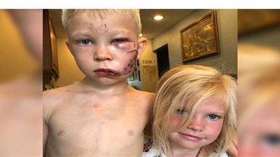 طفل يتصدى لكلب شرس دفاعا عن شقيقته