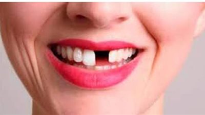 تفسير رؤية سقوط الأسنان في المنام وعلاقتها بالمال والموت والشعور بالإحباط