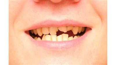 أهمية الحشوات التجميلية البيضاء في إعادة المظهر الجمالي للأسنان