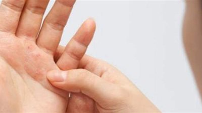 طرق منزلية فعالة لعلاج أعراض الصدفية على الجلد