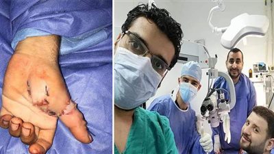 فريق طبي ينجح في إعادة توصيل أصبع مبتور بيد مريض بمستشفى جامعة المنوفية | صور
