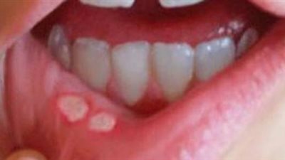 أسباب الإصابة بتقرحات الفم وطرق علاجها