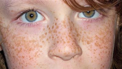 ثلاثية العناية بالبشرة والقضاء على «النمش»