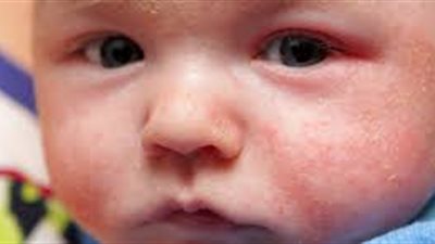 8 أطعمة تسبب الحساسية عند الأطفال