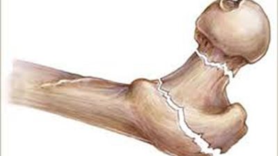 وصفة مصرية تخلصك من آلام وهشاشة العظام