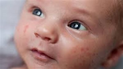 ارتفاع درجة حرارة طفلك تسبب له الطفح الجلدي