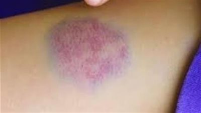 ليس سرطانا.. أسباب البقع الزرقاء في الجسم