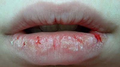 4 وصايا تجميلية لعلاج تشقق الشفاة