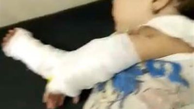 بالصور.. أب يلقي ماء نار على طفلته وطليقته بفارسكور