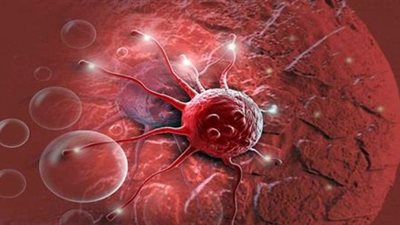 أستاذ أورام يكشف عن العلاجات الحديثة للسرطان