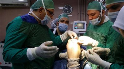 إجراء عمليات تغيير مفصل لـ100 مريض بـ«بني سويف الجامعي»