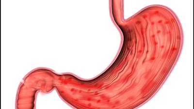 5 طرق للتخلص من التهاب جدار المعدة