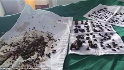 إزالة 200 حصاة من داخل كبد ومرارة امرأة